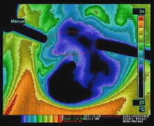 8 Months Post-Cryoablation Thermogram