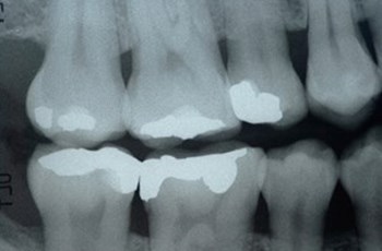 Five Common Sources of Mercury Exposure